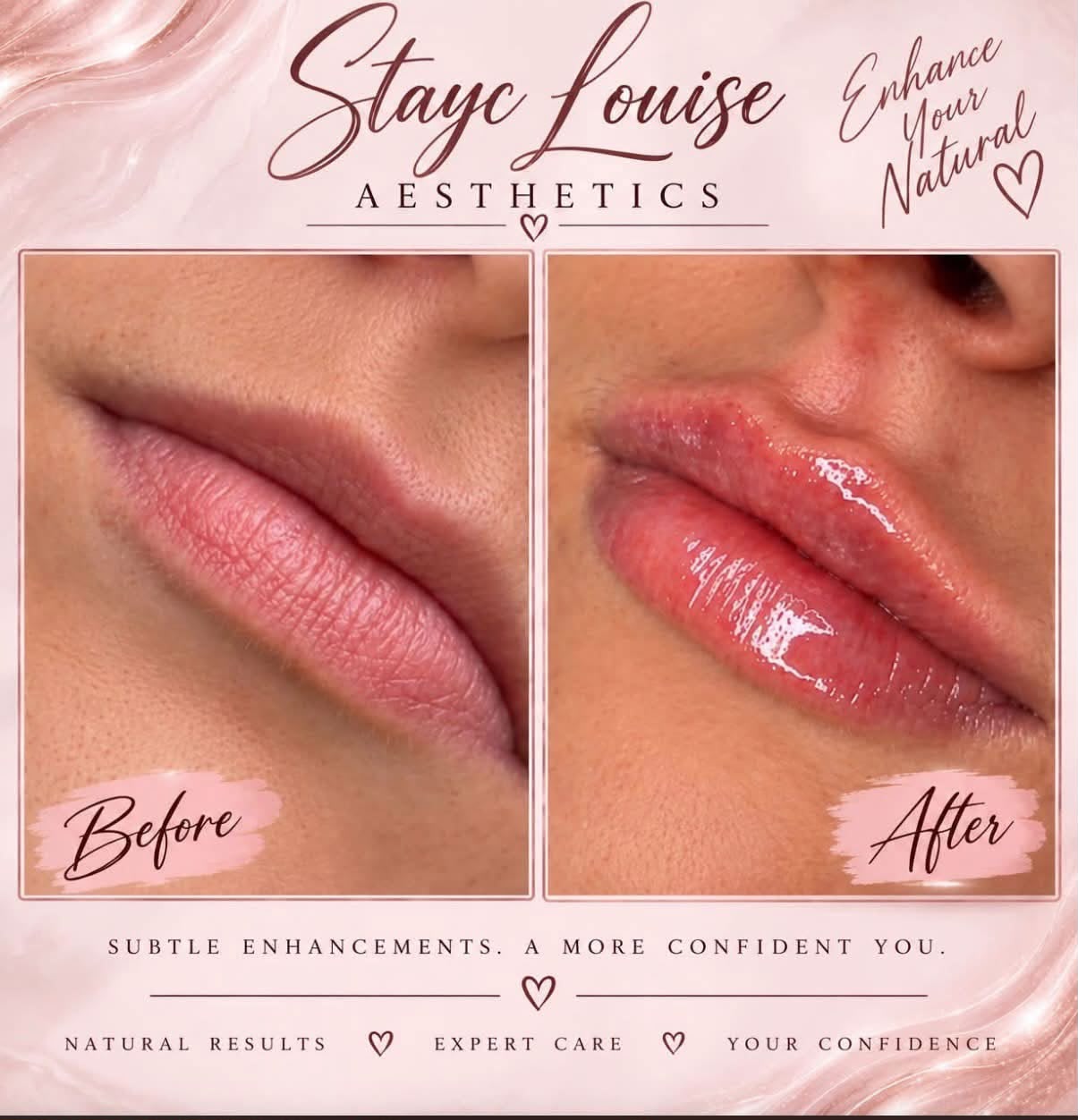 Lip enhancement before and after